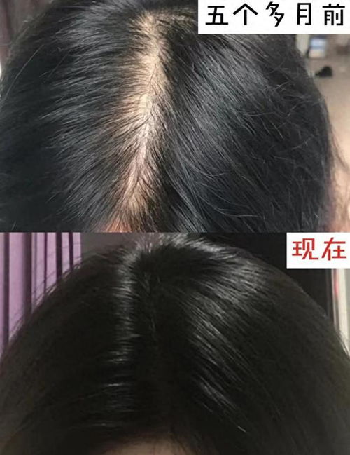 秃头吃什么长头发快方法 秃头吃什么长头发快方法最有效