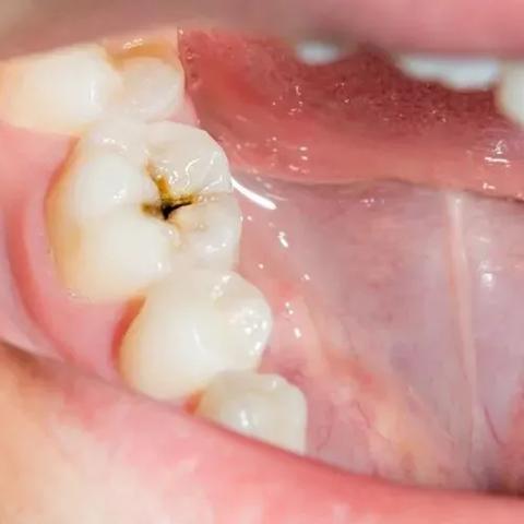 儿童龋齿修复推荐的牙膏 儿童龋齿修复推荐的牙膏有用吗
